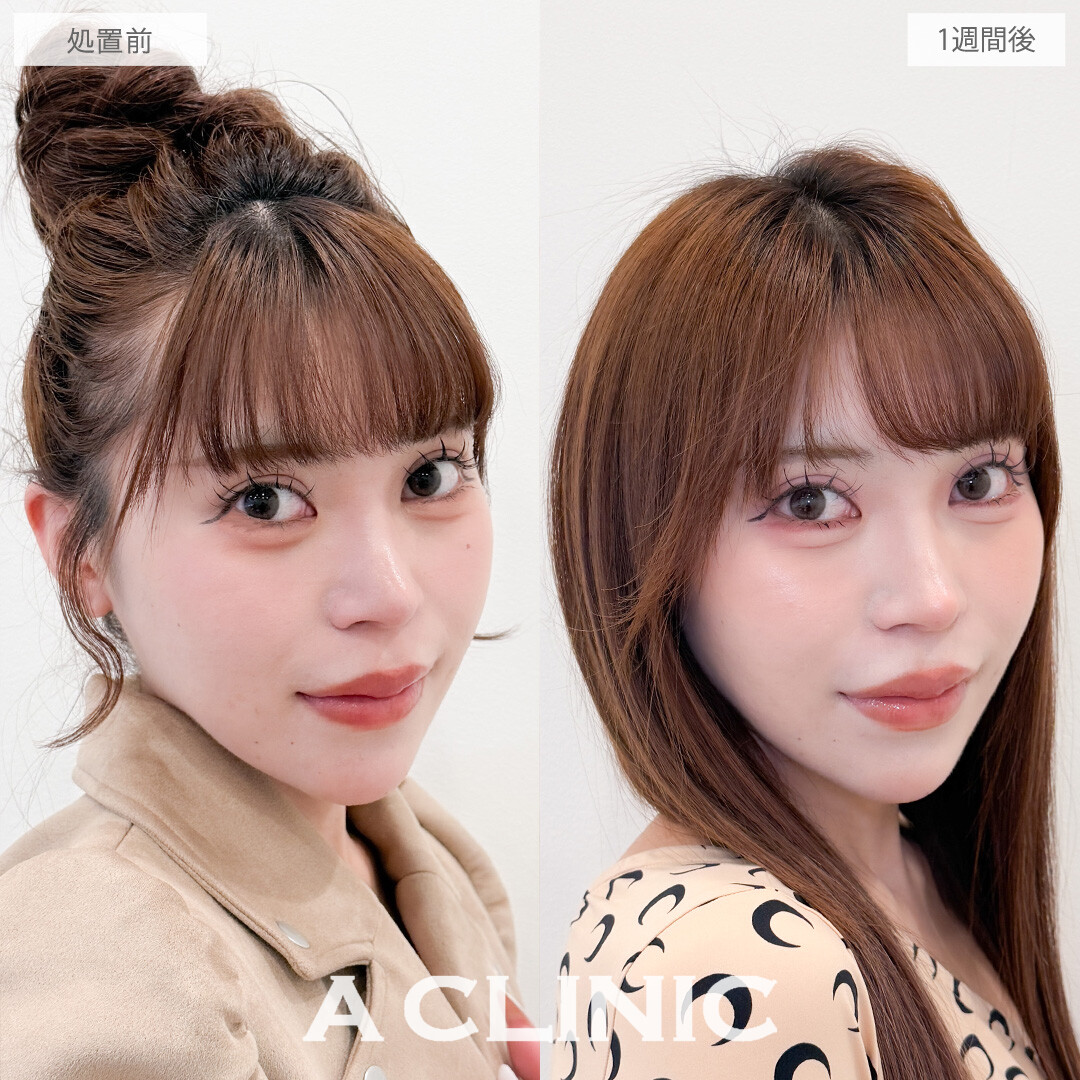 パーフェクトアイズでつり目を緩和させて優しい印象の目元になりました！こちら処置前と1週間後の症例です(20代女性)