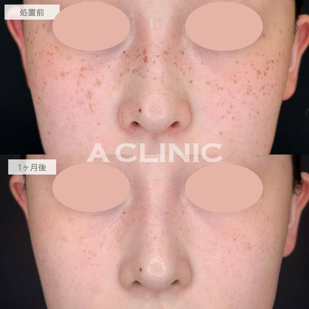 ピコスポットで気になっていたシミやそばかすもここまできれいになります！こちら処置前と1か月後の症例です(20代女性)