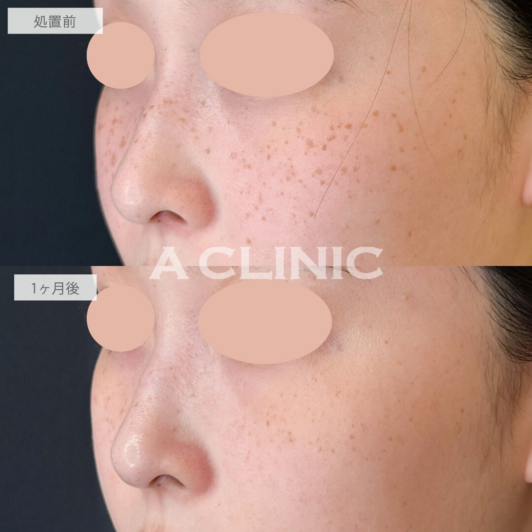 ピコスポットで気になっていたシミやそばかすもここまできれいになります！こちら処置前と1か月後の症例です(20代女性)