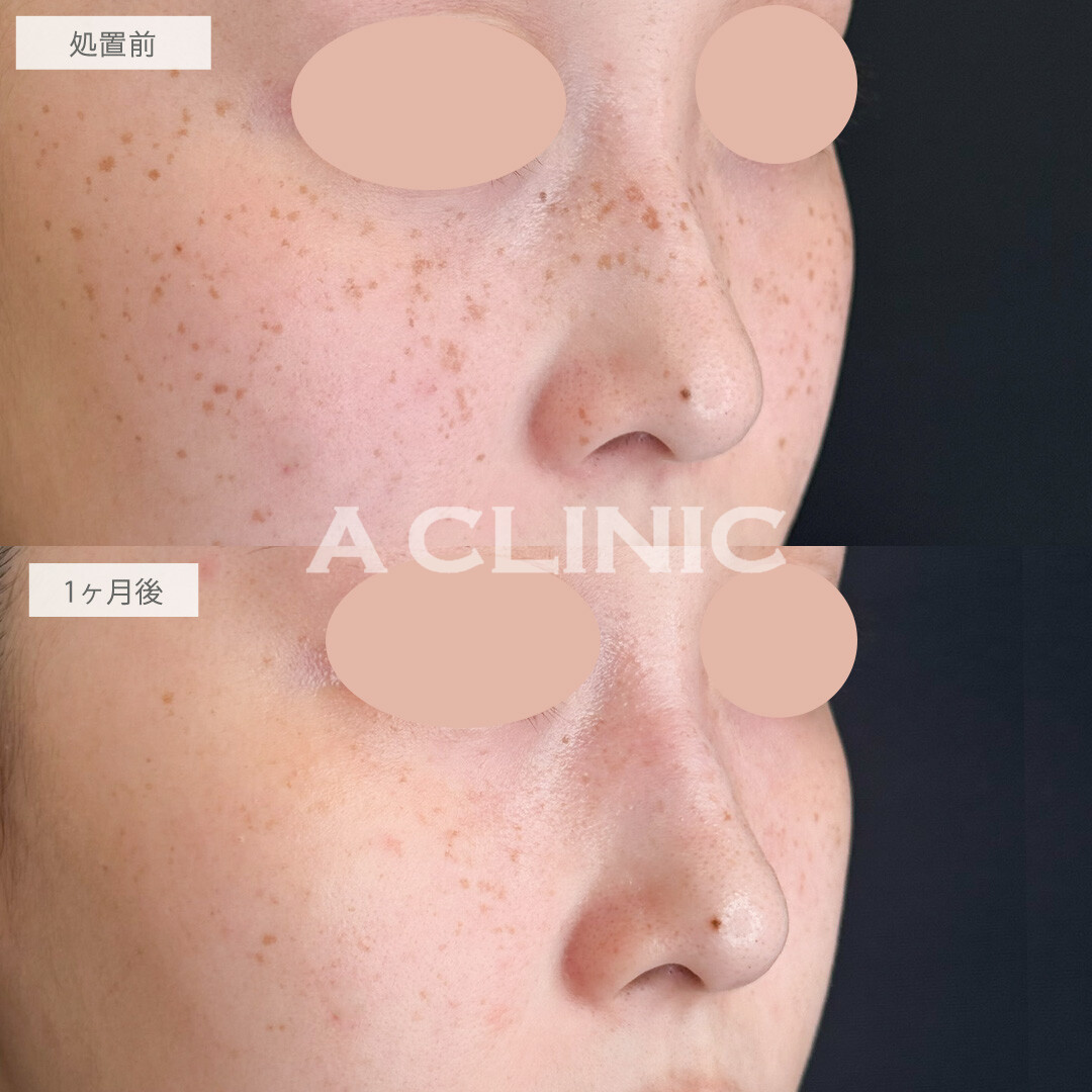 ピコスポットで気になっていたシミやそばかすもここまできれいになります！こちら処置前と1か月後の症例です(20代女性)