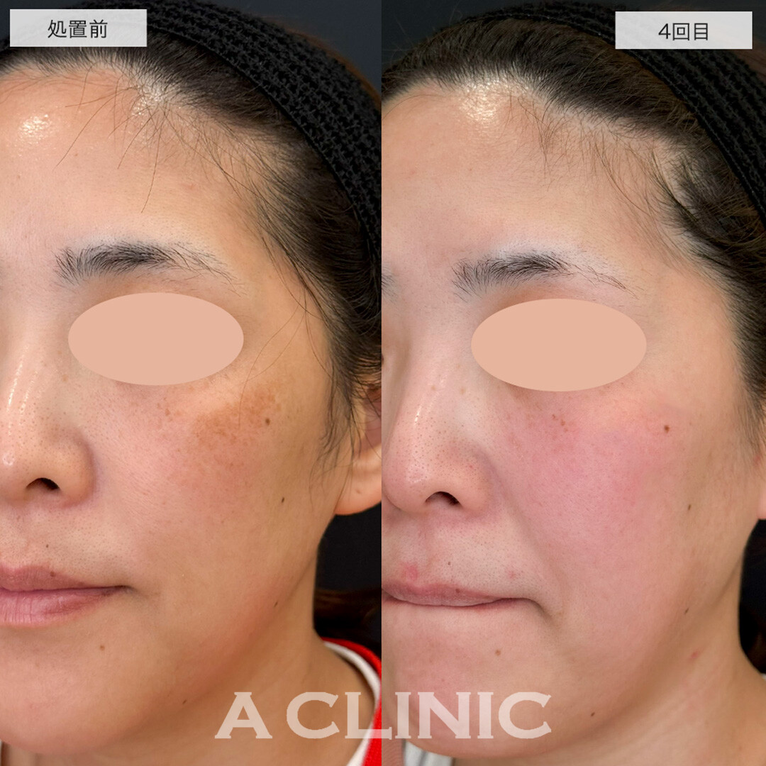 ポテンツァで肝斑を改善しクリアな素肌に!こちら処置前と4回目の症例です(30代女性)