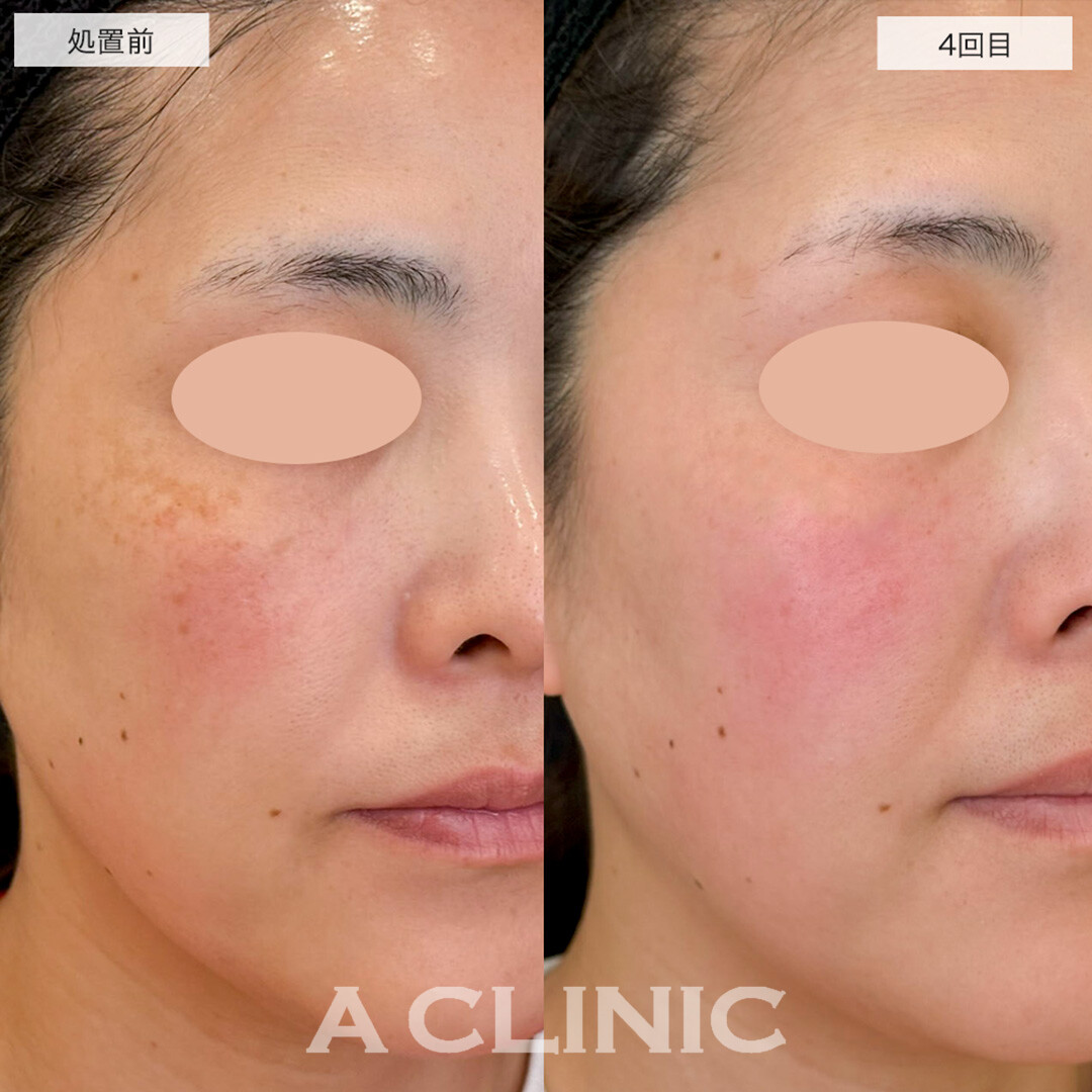 ポテンツァで肝斑を改善しクリアな素肌に!こちら処置前と4回目の症例です(30代女性)