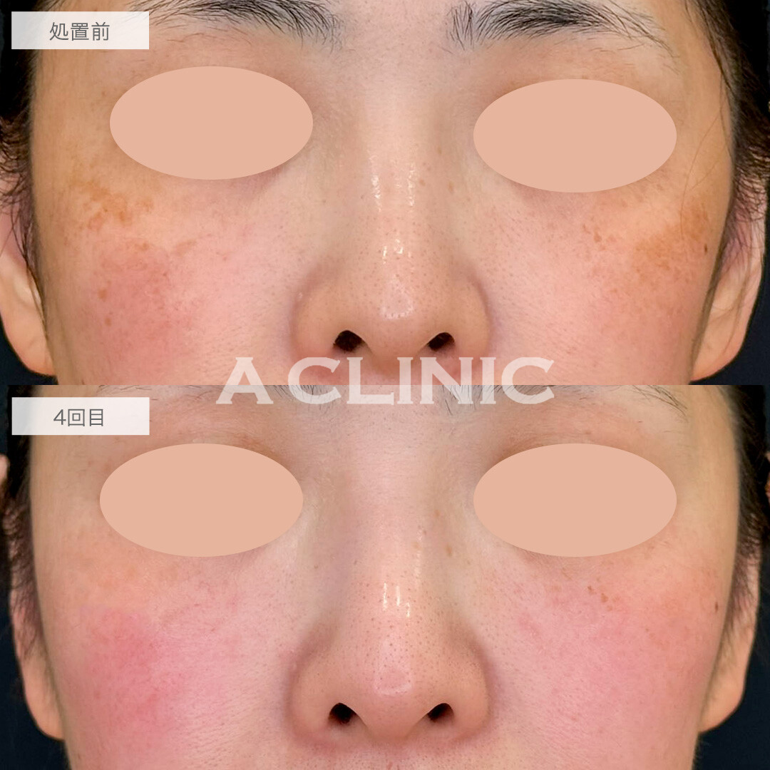 ポテンツァで肝斑を改善しクリアな素肌に!こちら処置前と4回目の症例です(30代女性)