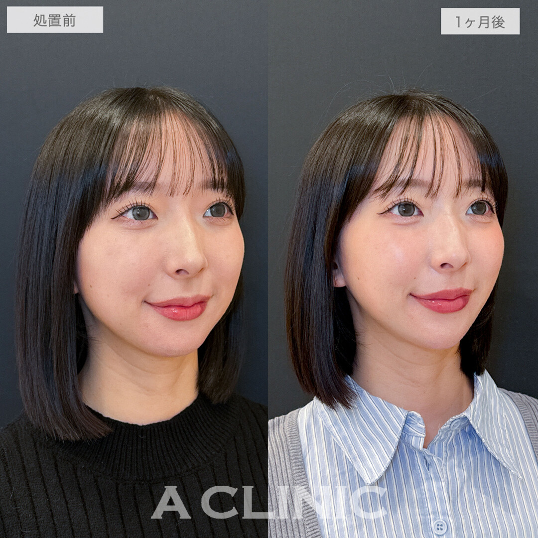 1day小顔脂肪吸引とあごへのヒアルロン酸注入で周りから褒められる唯一無二の小顔に！処置前と1ヶ月後の症例です(20代女性)