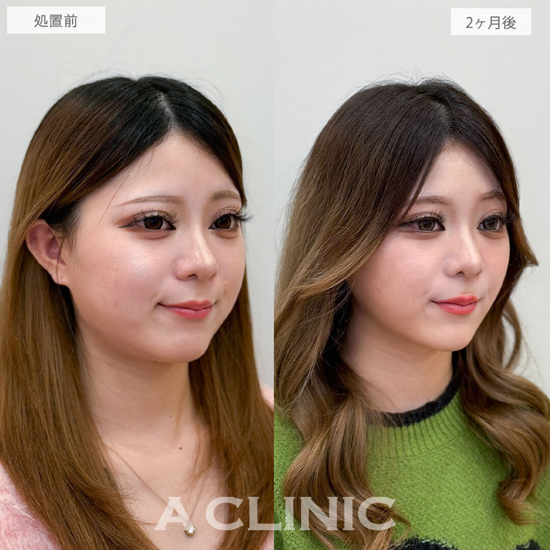 1day小顔脂肪吸引と小顔エラボトックスで首との境目がクッキリシャープになりました！処置前と2ヶ月後の症例です(20代女性)