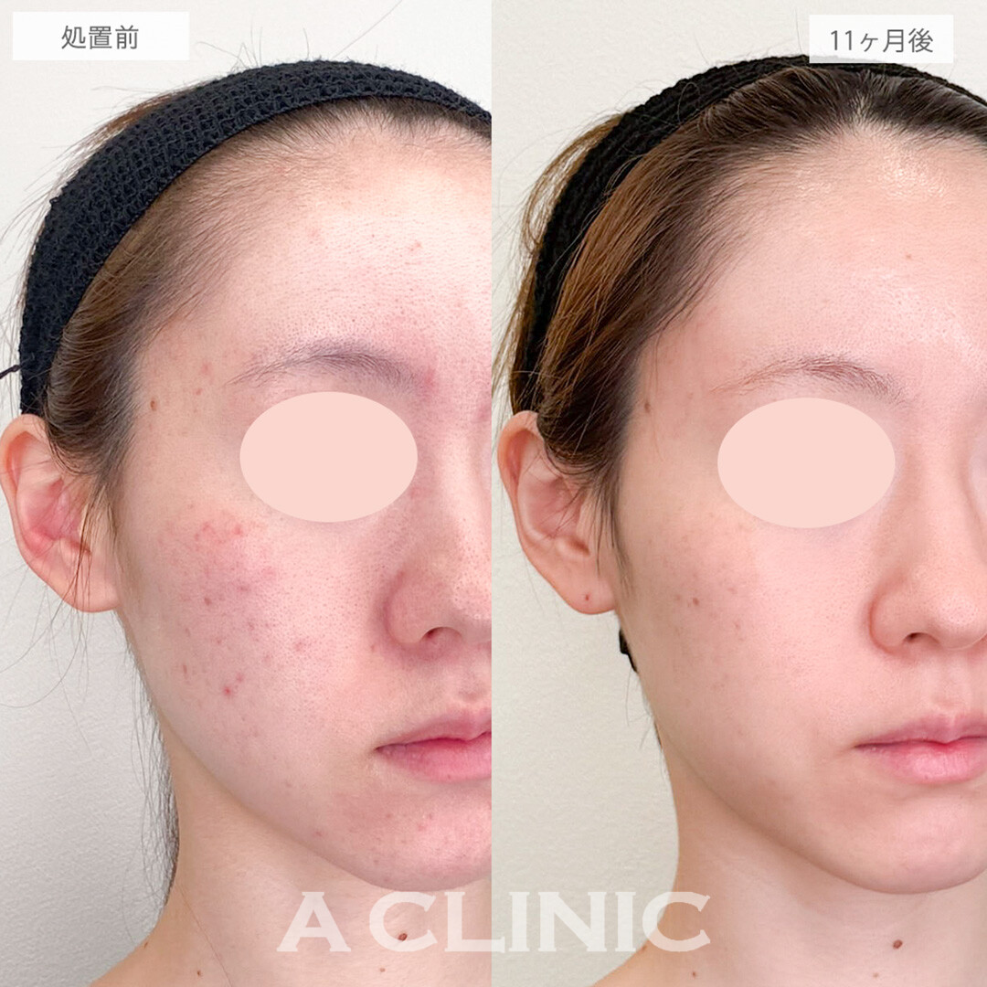 イソトレチノインとポテンツァとエレクトロポレーションでニキビの根本治療と再発防止が同時に叶う！処置前と11ヶ月後の症例です(20代女性)