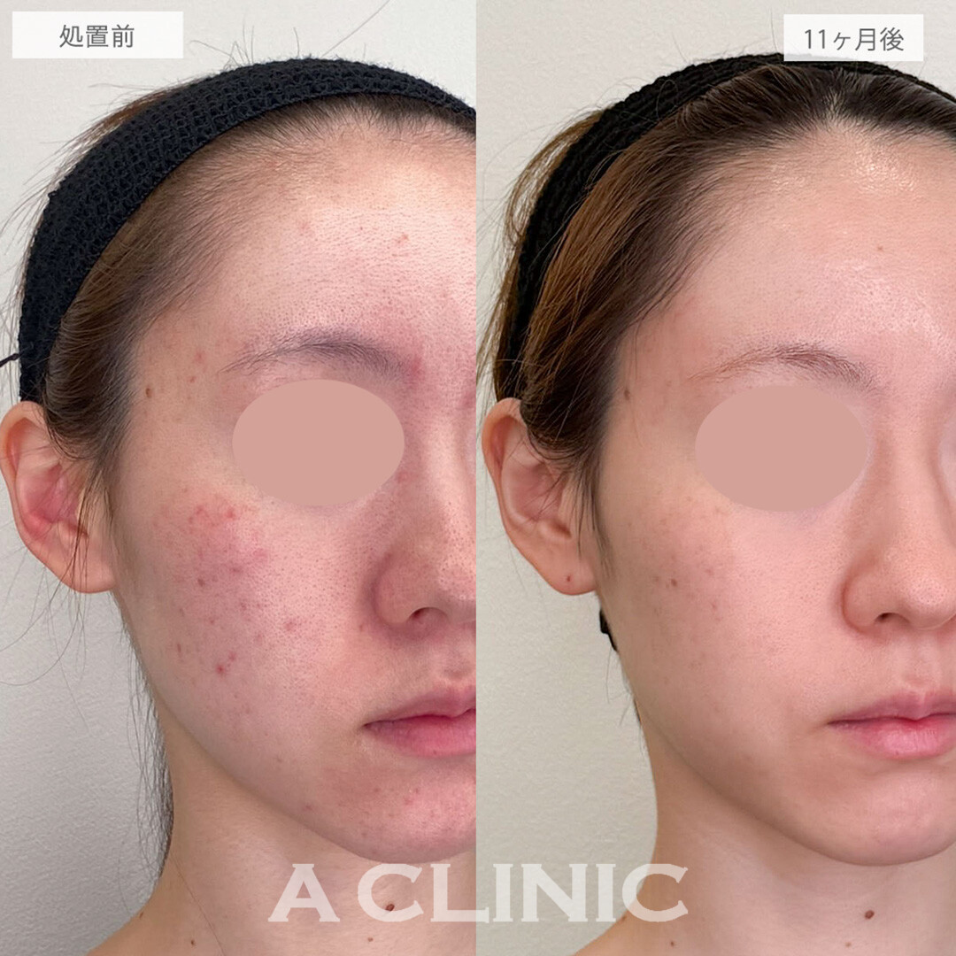 イソトレチノインとポテンツァとエレクトロポレーションでニキビの根本治療と再発防止が同時に叶う！処置前と11ヶ月後の症例です(20代女性)