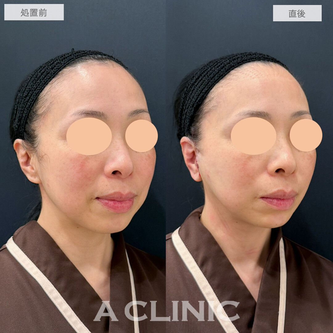 A式美肌たるみ切開とあごへのヒアルロン酸注入でたるみがぐっと引きあがり直後から若返りが可能に！処置前と直後の症例です(40代女性)