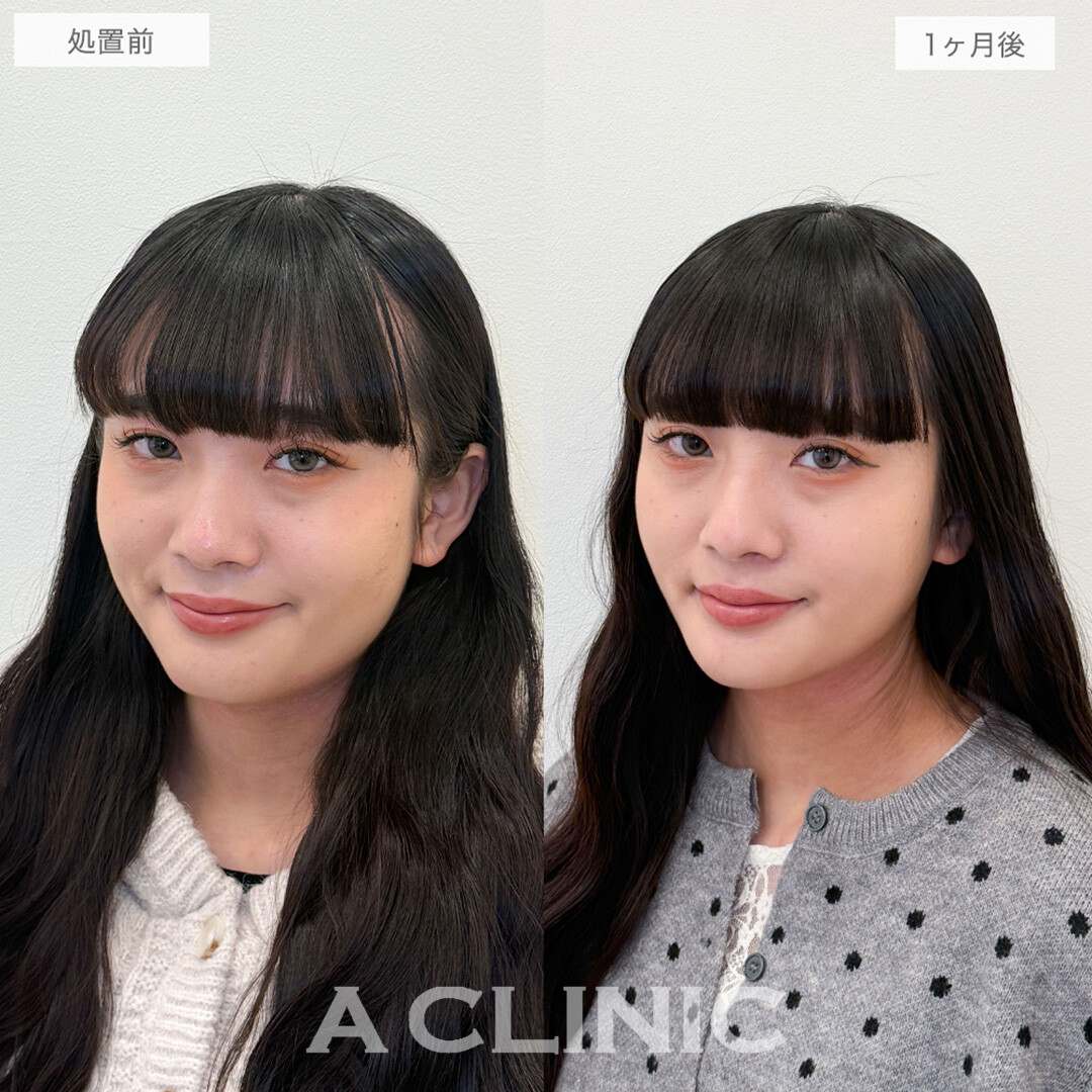 1day小顔脂肪吸引と小顔エラボトックスで周りから褒められる究極の小顔が手に入りました！処置前と1ヶ月後の症例です(20代女性)