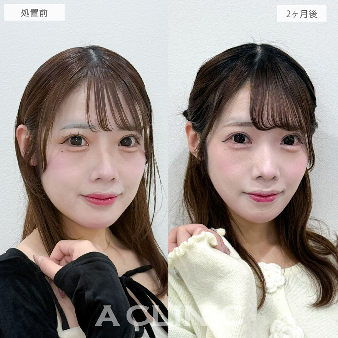 1day小顔脂肪吸引とバッカルファット除去術で小顔と将来的なたるみ予防が同時に叶います！処置前と2ヶ月後の症例です(20代女性)