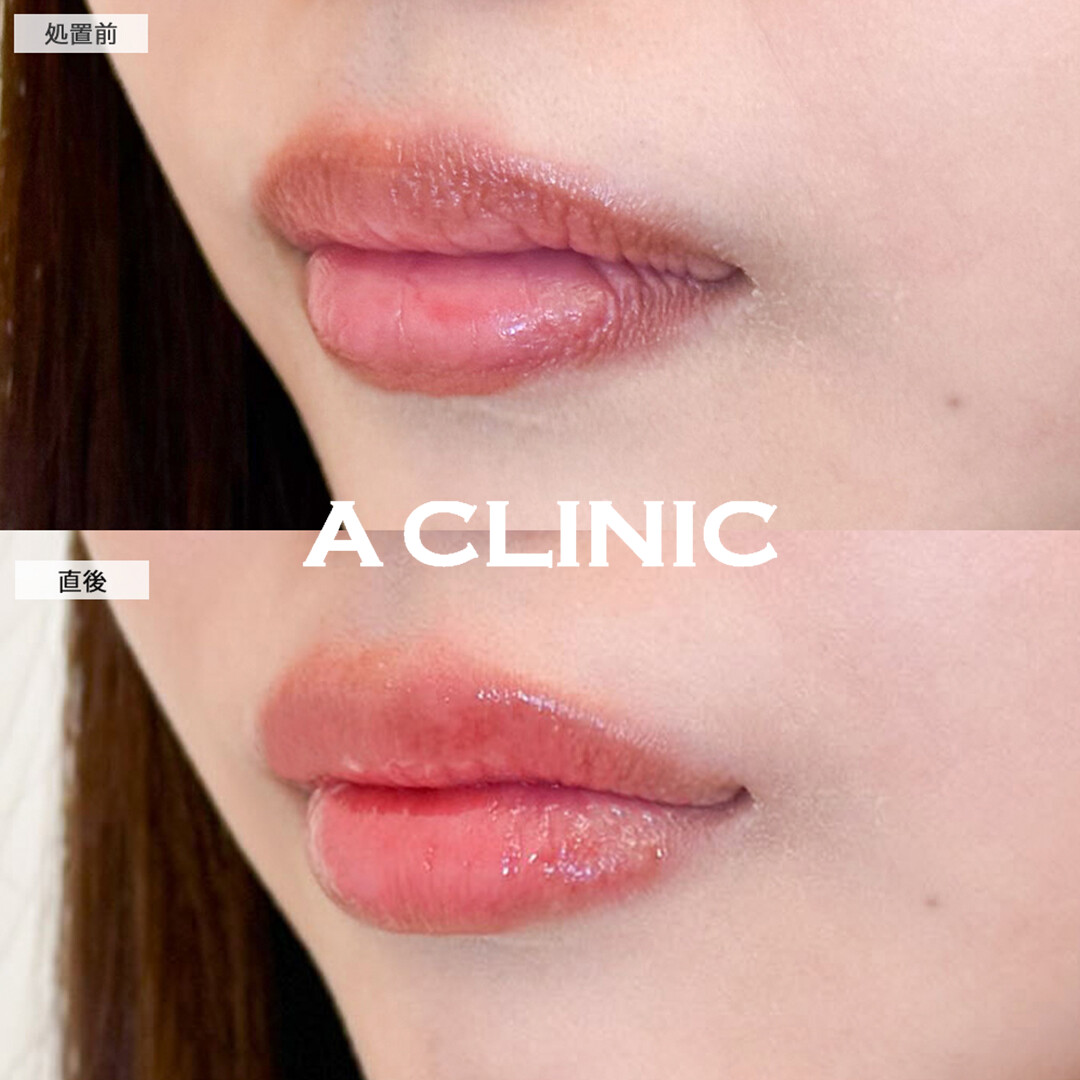 スマイルリップで直後からシワのないぷにっとした唇に！こちら処置前と直後の症例です(20代女性)