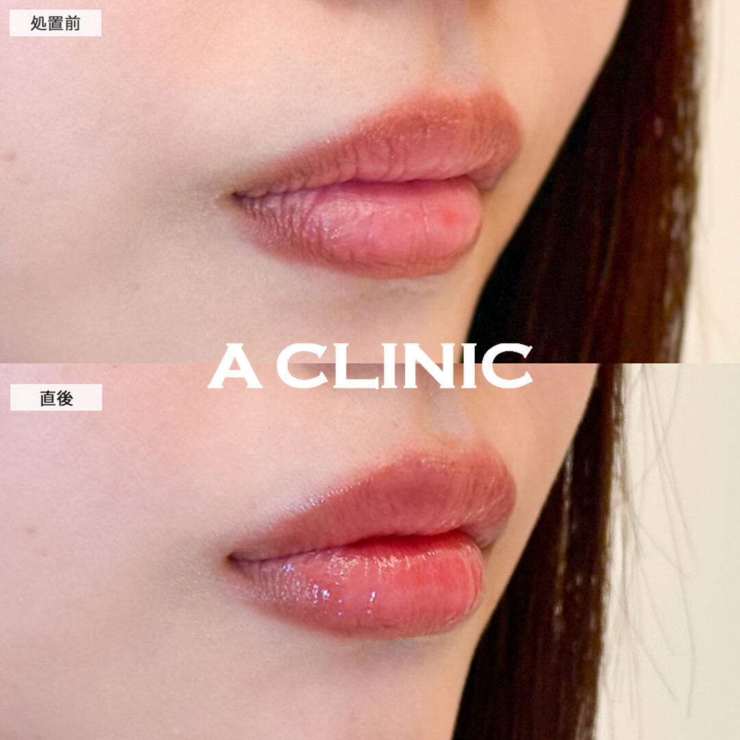 スマイルリップで直後からシワのないぷにっとした唇に！こちら処置前と直後の症例です(20代女性)