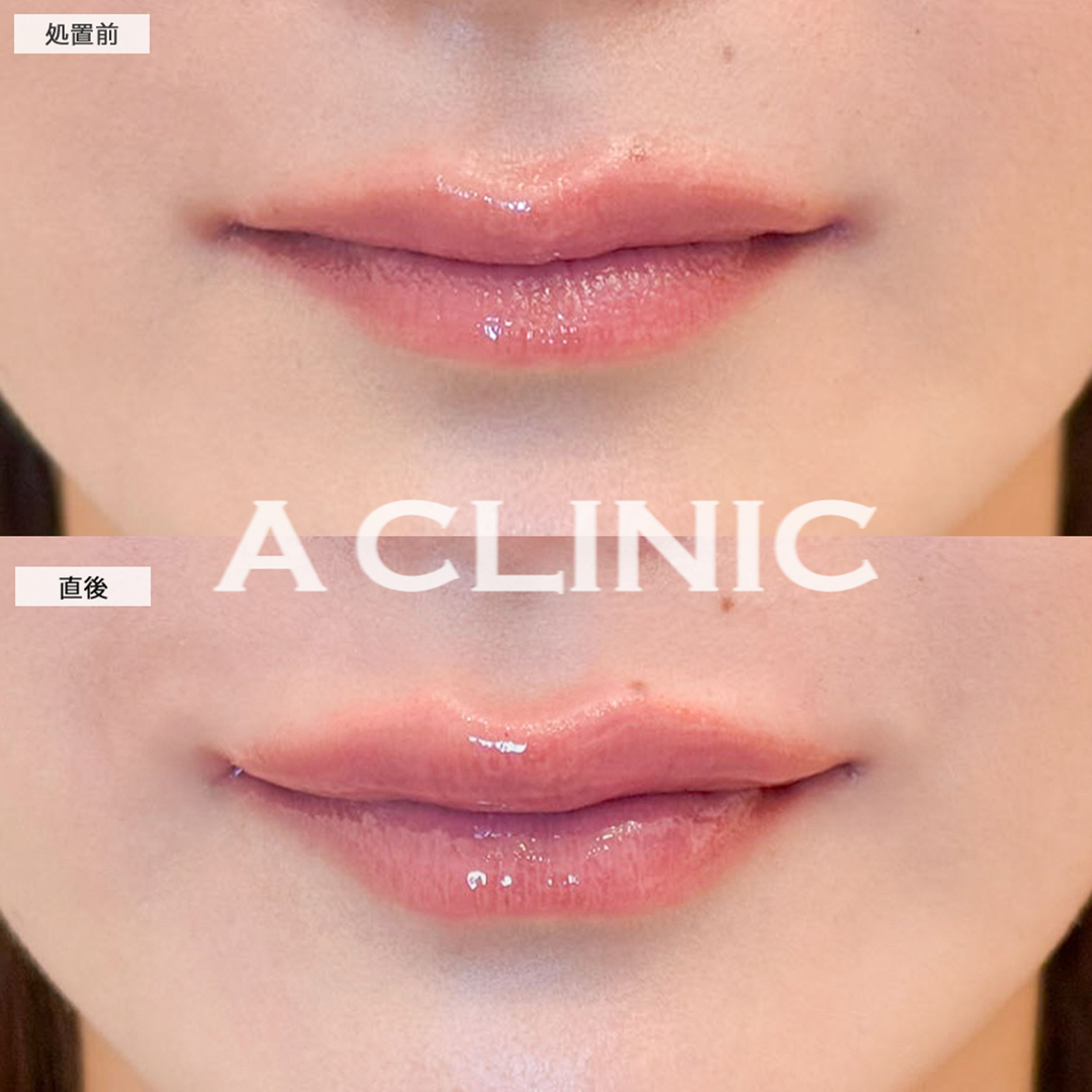 スマイルリップで自然と口角が上がる唇に！こちら処置前と直後の症例です(30代女性)