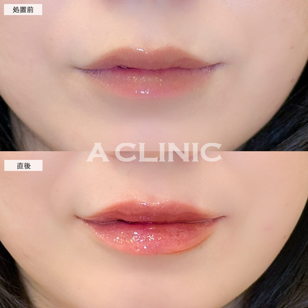 スマイルリップでお悩みだった唇の薄さ改善し存在感が出ました！こちら処置前と直後の症例です(30代女性)