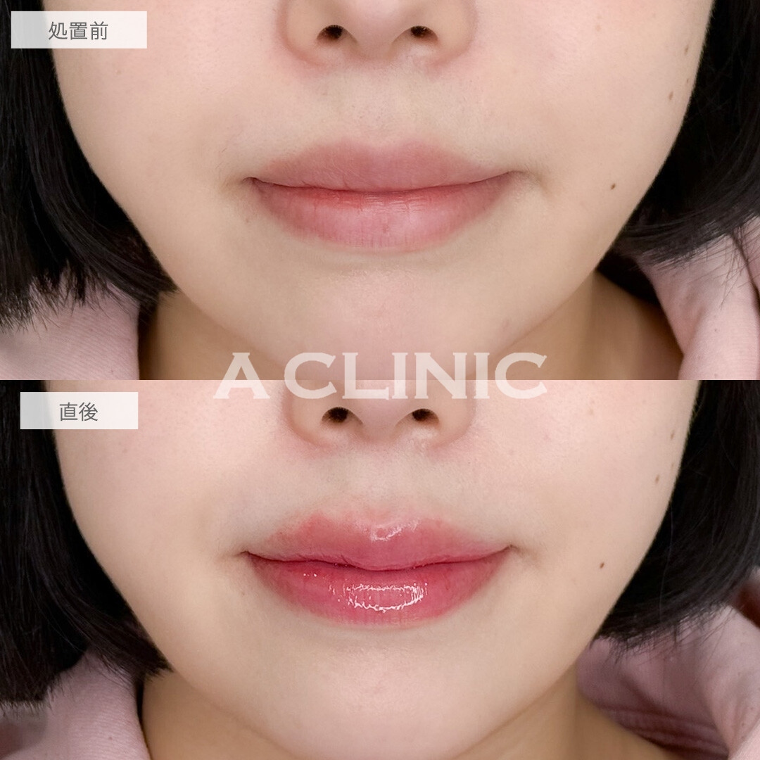 スマイルリップでM字リップになって人中も短縮！こちら処置前と直後の症例です(20代女性)