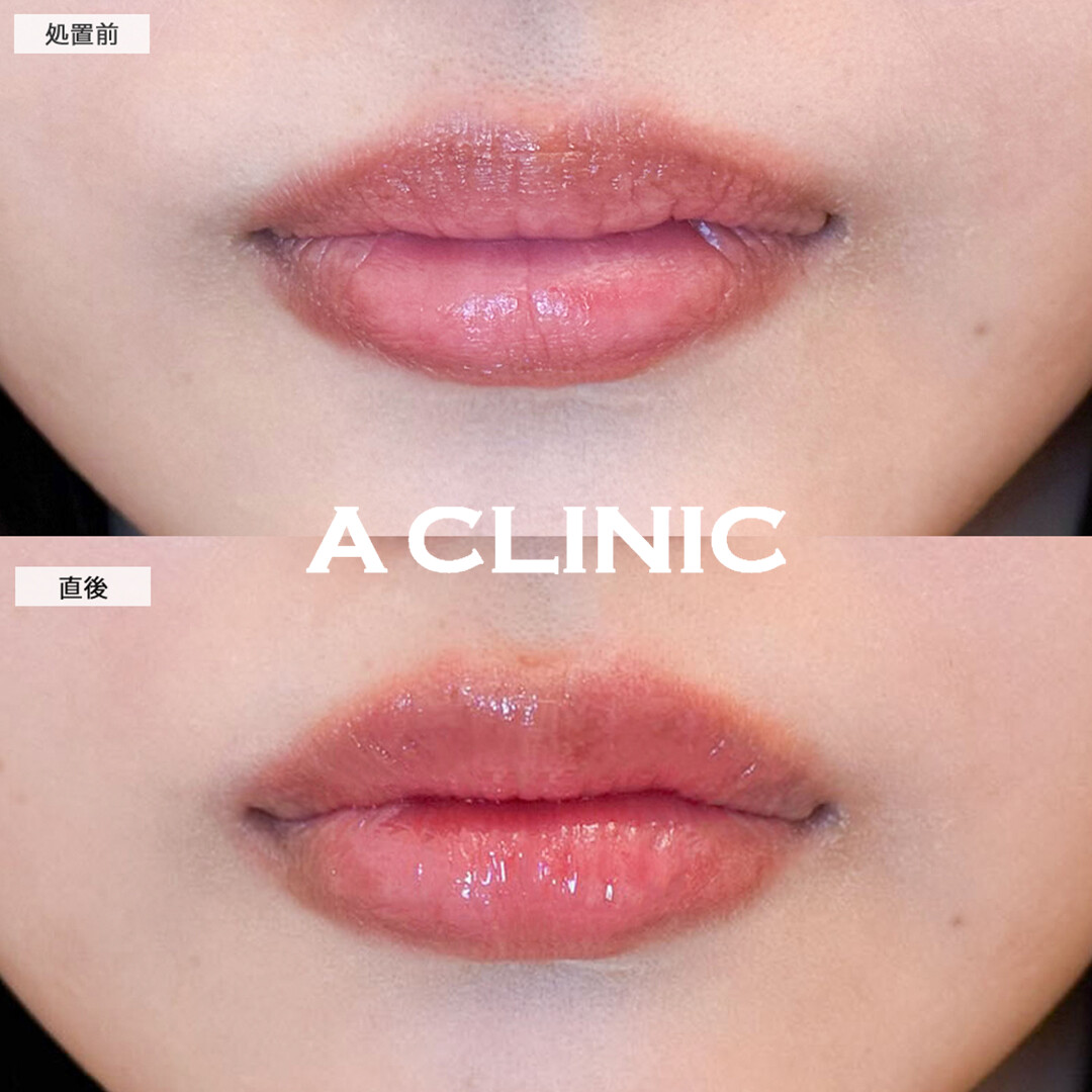 スマイルリップで直後からシワのないぷにっとした唇に！こちら処置前と直後の症例です(20代女性)