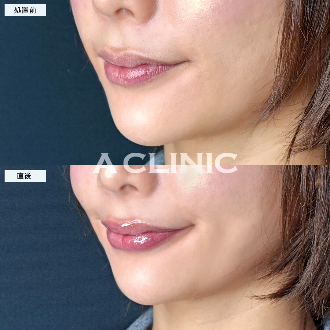 スマイルリップでハリのある立体的な唇になりました！処置前と直後の症例です(20代女性)