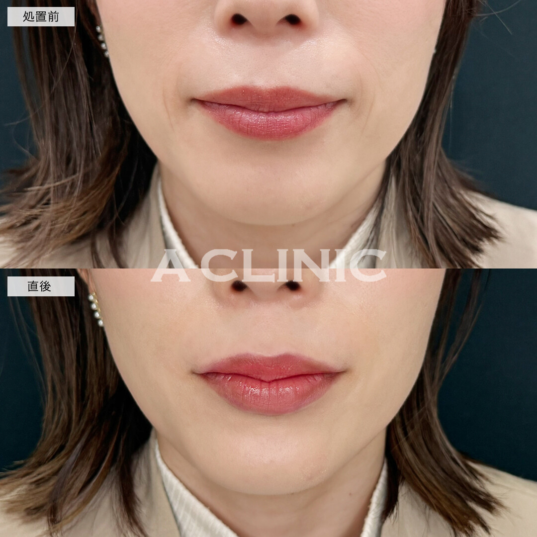 スマイルリップで綺麗なCカールを形成！処置前と直後の症例です(30代女性)