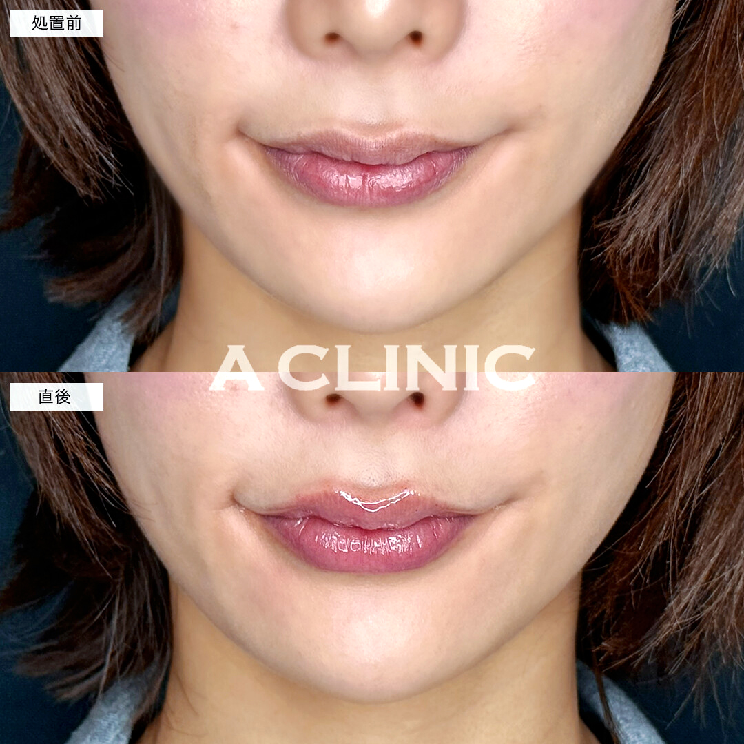 スマイルリップでハリのある立体的な唇になりました！処置前と直後の症例です(20代女性)
