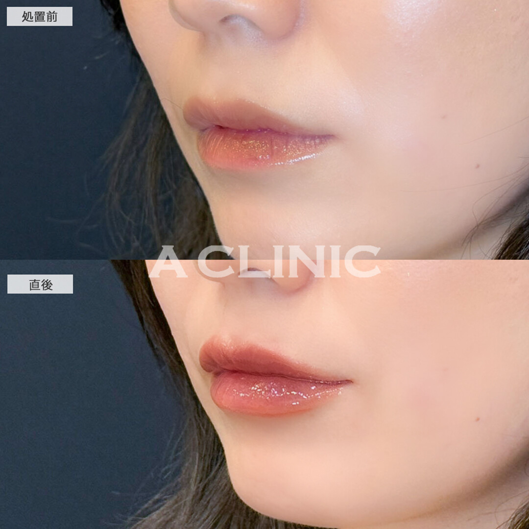 スマイルリップでお悩みだった唇の薄さ改善し存在感が出ました！こちら処置前と直後の症例です(30代女性)