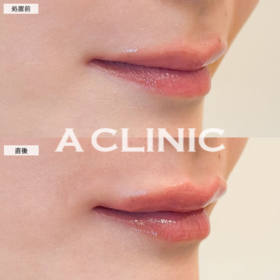 スマイルリップで自然と口角が上がる唇に！こちら処置前と直後の症例です(30代女性)