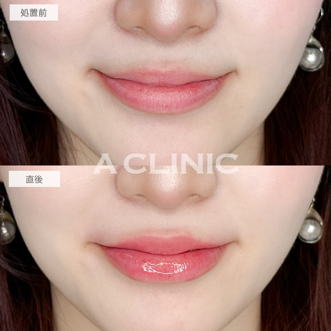 スマイルリップで唇の存在感アップ！処置前と直後の症例です(20代女性)