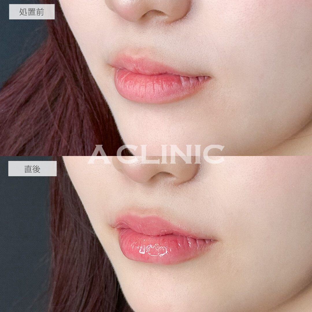 スマイルリップで唇の存在感アップ！処置前と直後の症例です(20代女性)