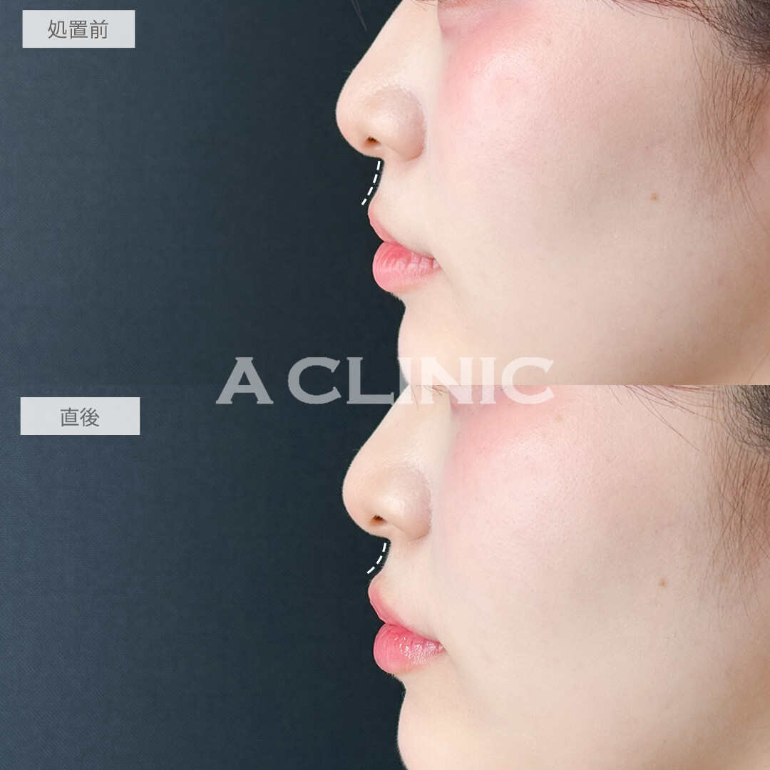 スマイルリップで唇の存在感アップ！処置前と直後の症例です(20代女性)