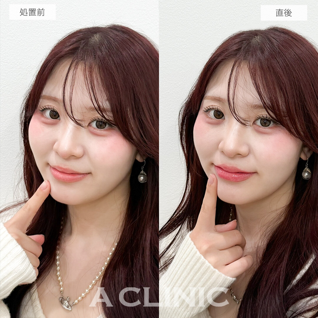 スマイルリップで唇の存在感アップ！処置前と直後の症例です(20代女性)