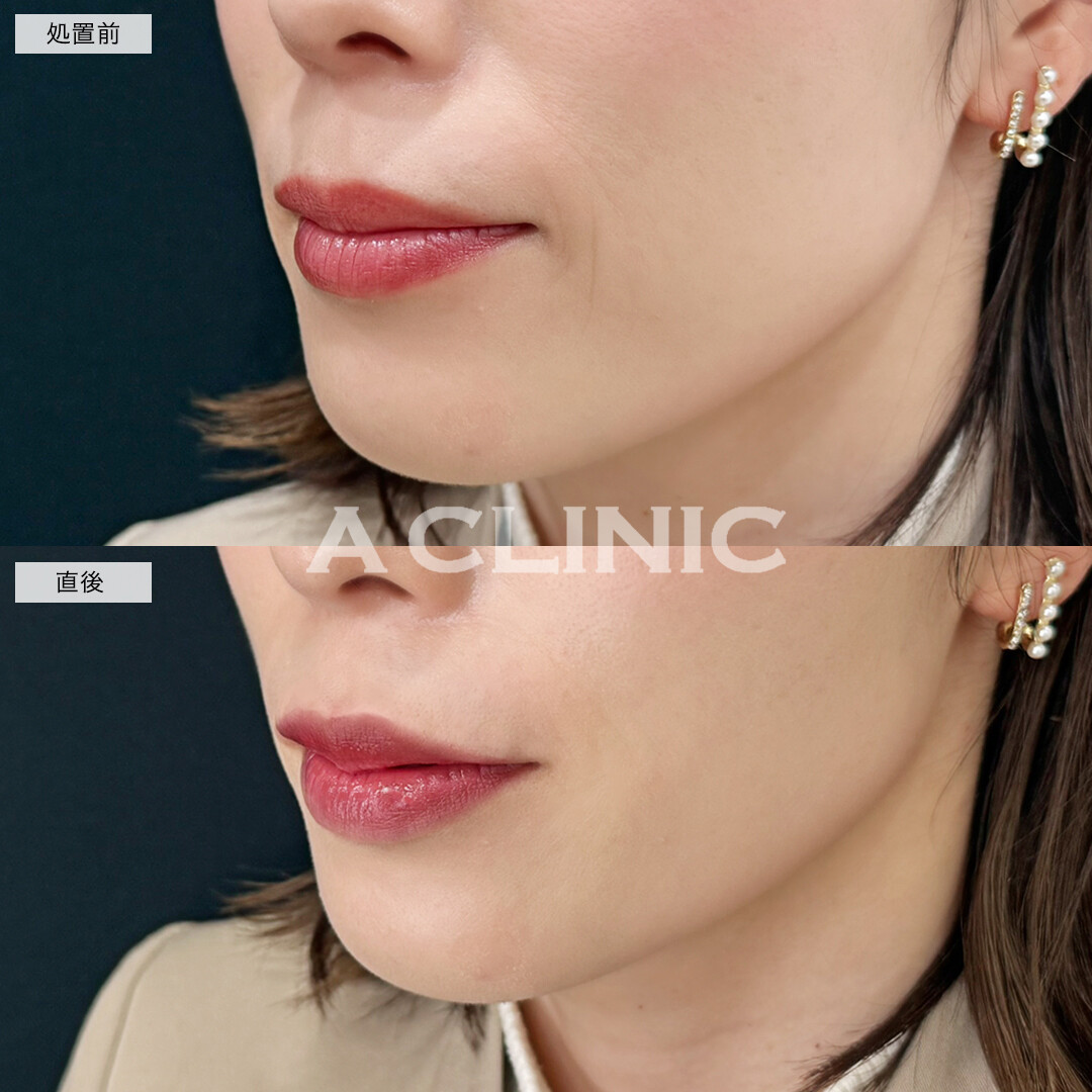 スマイルリップで綺麗なCカールを形成！処置前と直後の症例です(30代女性)