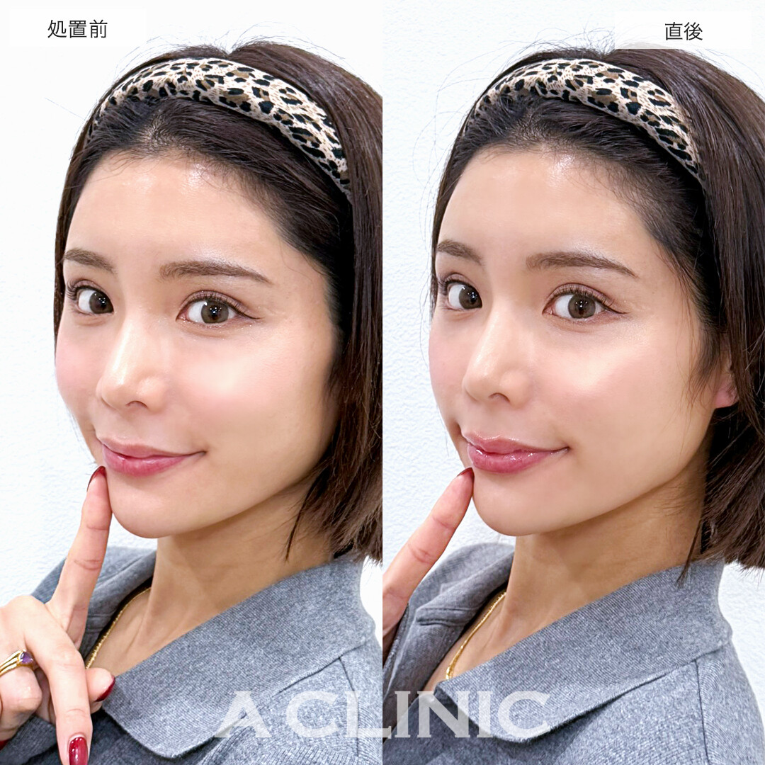 スマイルリップでハリのある立体的な唇になりました！処置前と直後の症例です(20代女性)