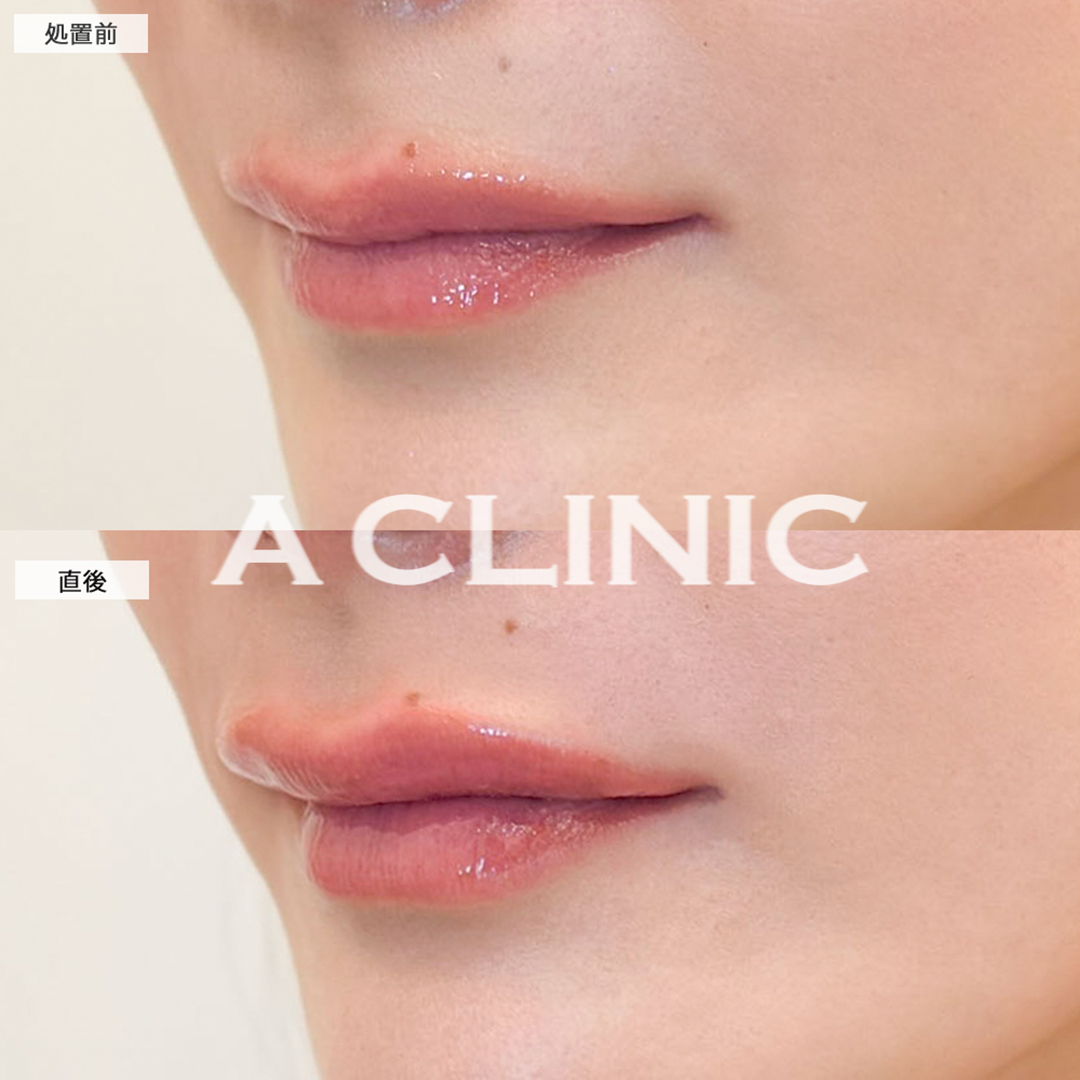 スマイルリップで自然と口角が上がる唇に！こちら処置前と直後の症例です(30代女性)