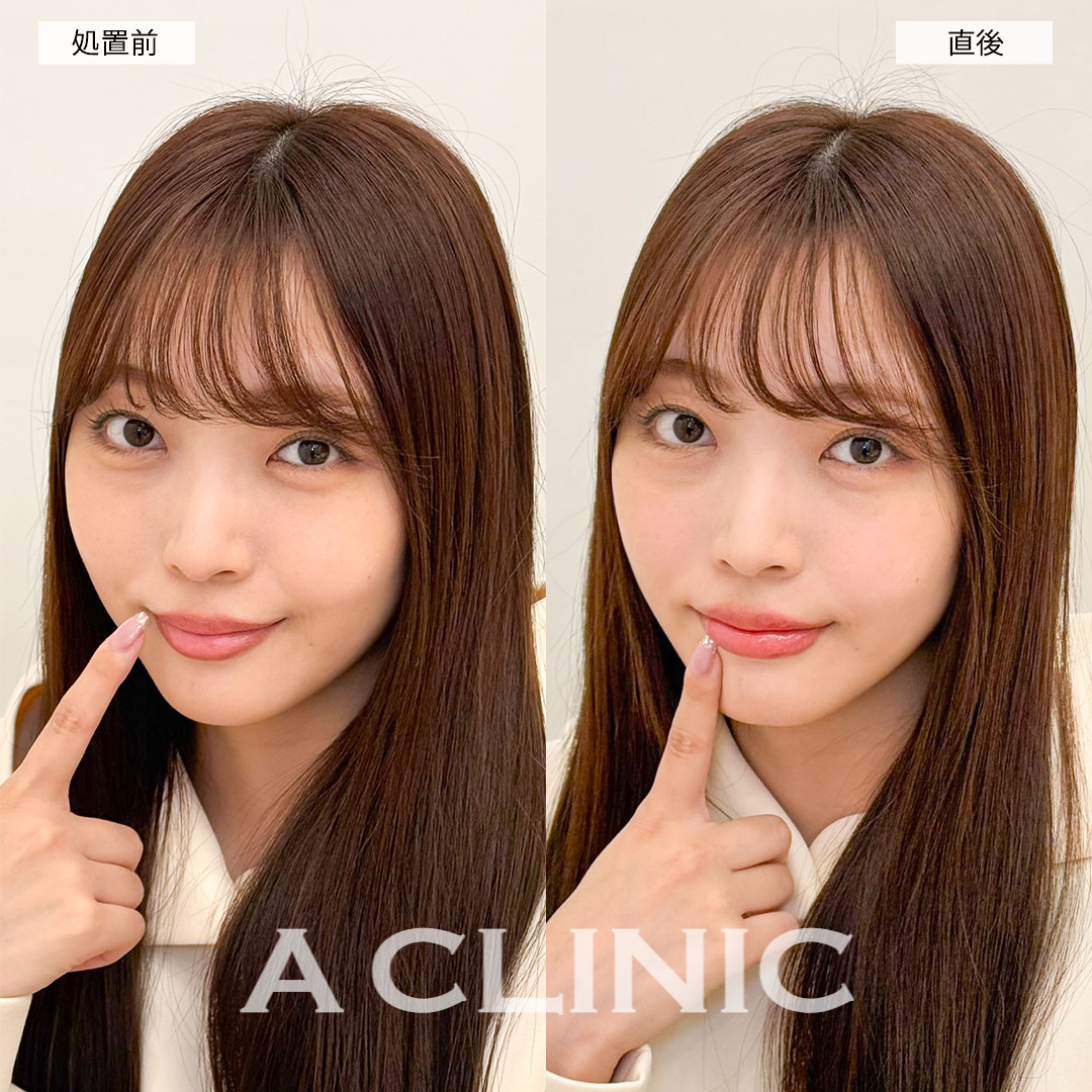 スマイルリップで直後からシワのないぷにっとした唇に！こちら処置前と直後の症例です(20代女性)