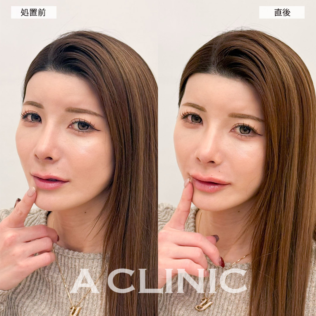 スマイルリップで自然と口角が上がる唇に！こちら処置前と直後の症例です(30代女性)