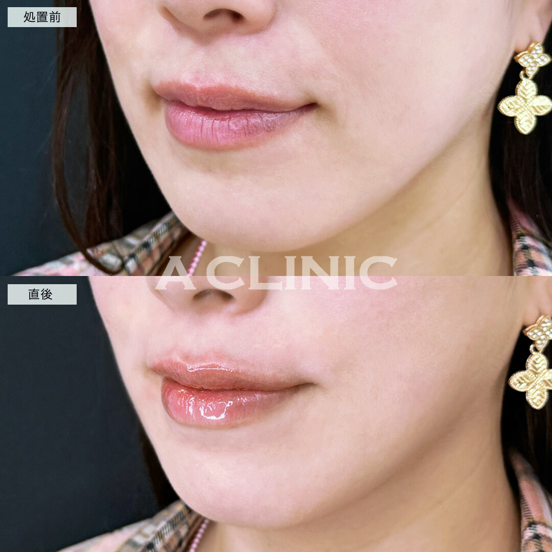 スマイルリップでメリハリのあるM字ラインが完成！施術前と直後の症例です(30代女性)