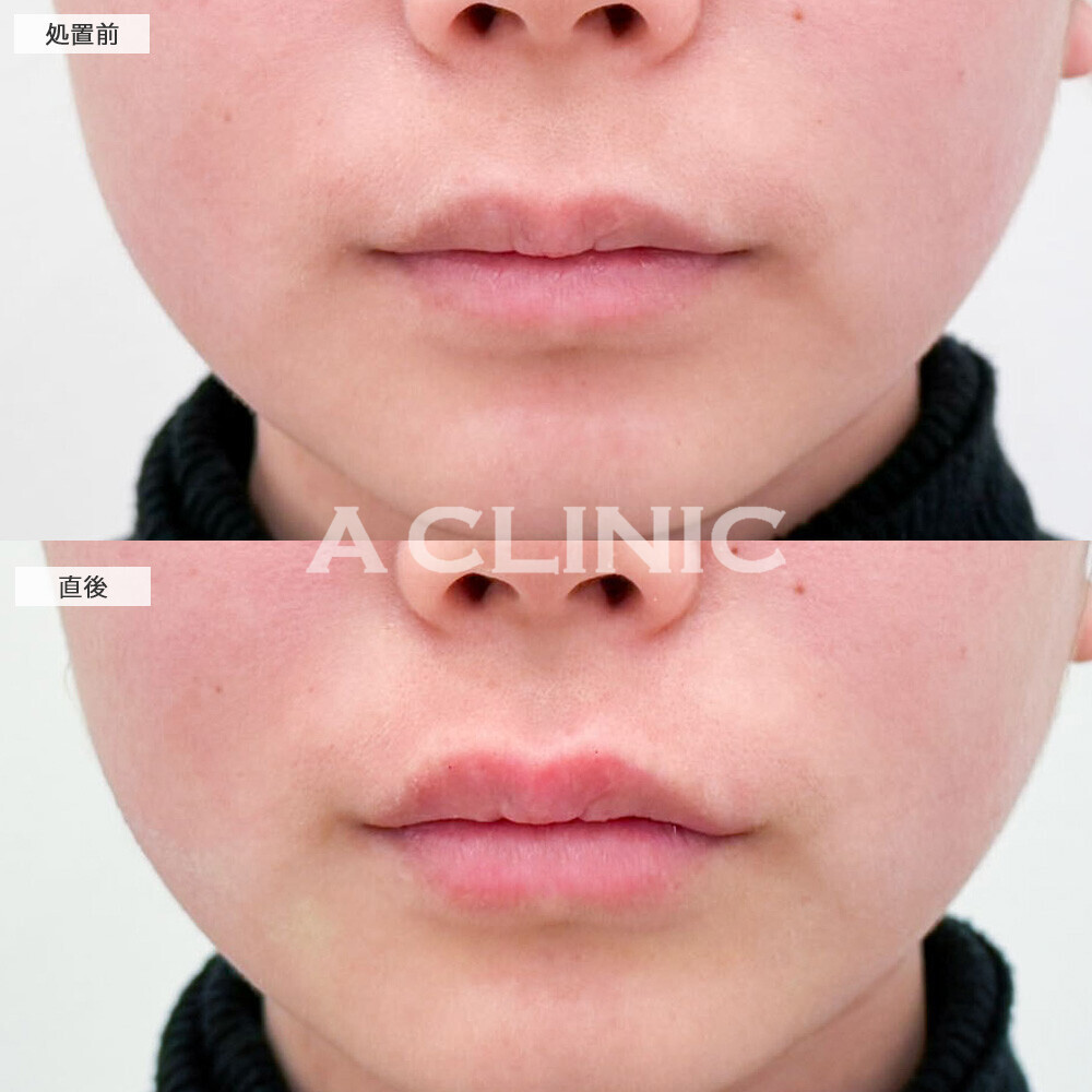 リップヒアルロン酸注入でグロスなしでも立体的な唇に！処置前と直後の症例です(20代女性)