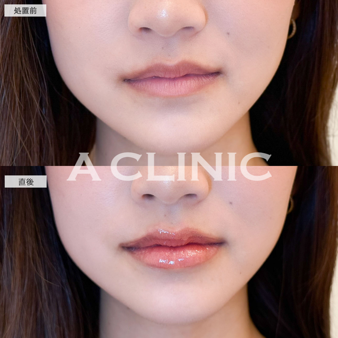 スマイルリップで人中も短くなり化粧も楽になりました！こちら処置前と直後の症例です(20代女性)