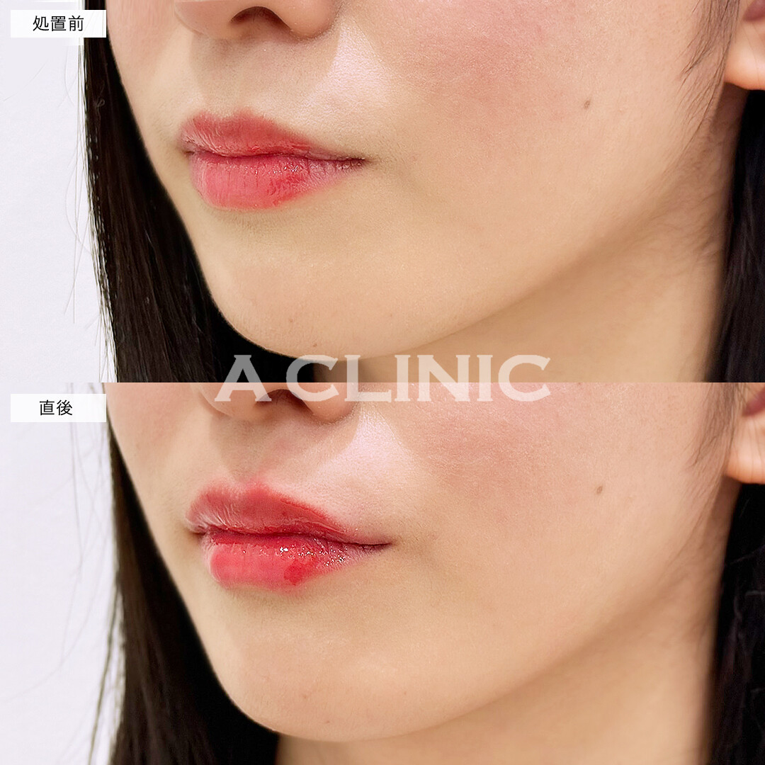 スマイルリップで唇のボリュームが出て人中短縮効果も！処置前と直後の症例です(20代女性)
