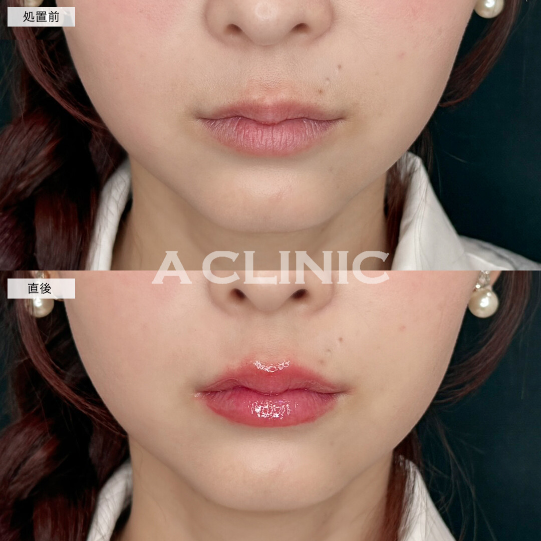 スマイルリップでボリュームのあるぷっくり唇に！処置前と直後の症例です(30代女性)
