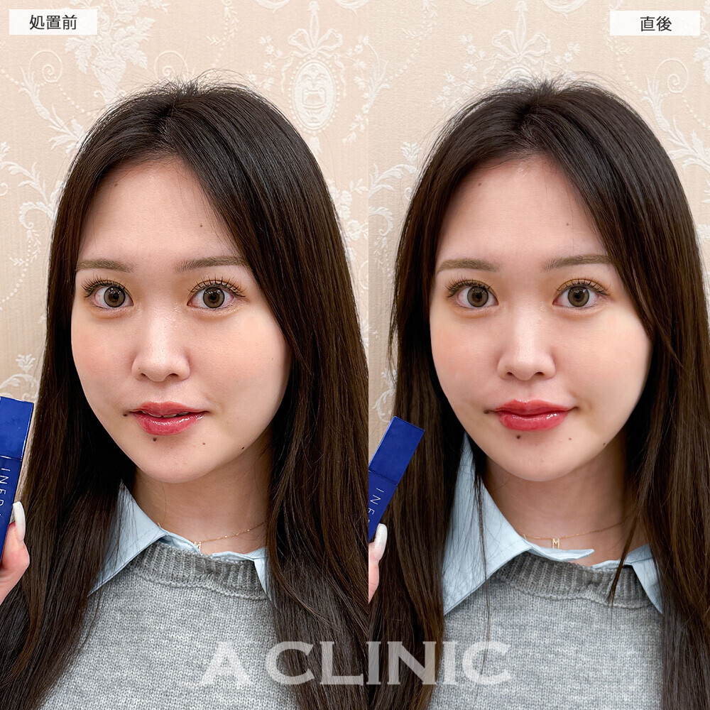 スマイルリップで適度な厚みが出てパーツがはっきりしました！こちら処置前と直後の症例です(20代女性)