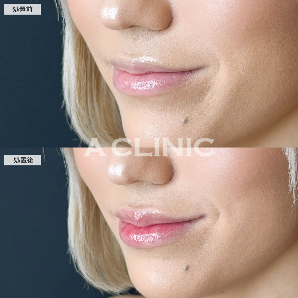 唇のヒアルロン酸注入でぷっくり印象的な口元に！こちらスマイルリップの施術前と直後の症例です(20代女性)