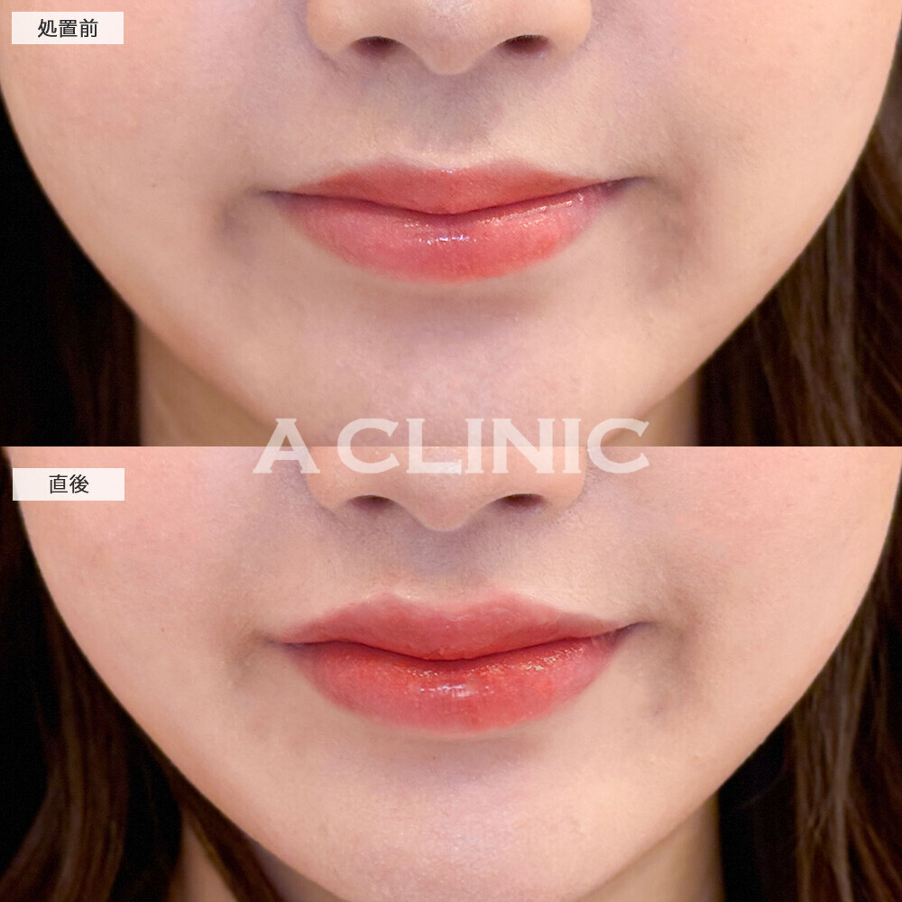 スマイルリップで存在感のある可愛い唇に！こちら処置前と直後の症例です(20代女性)