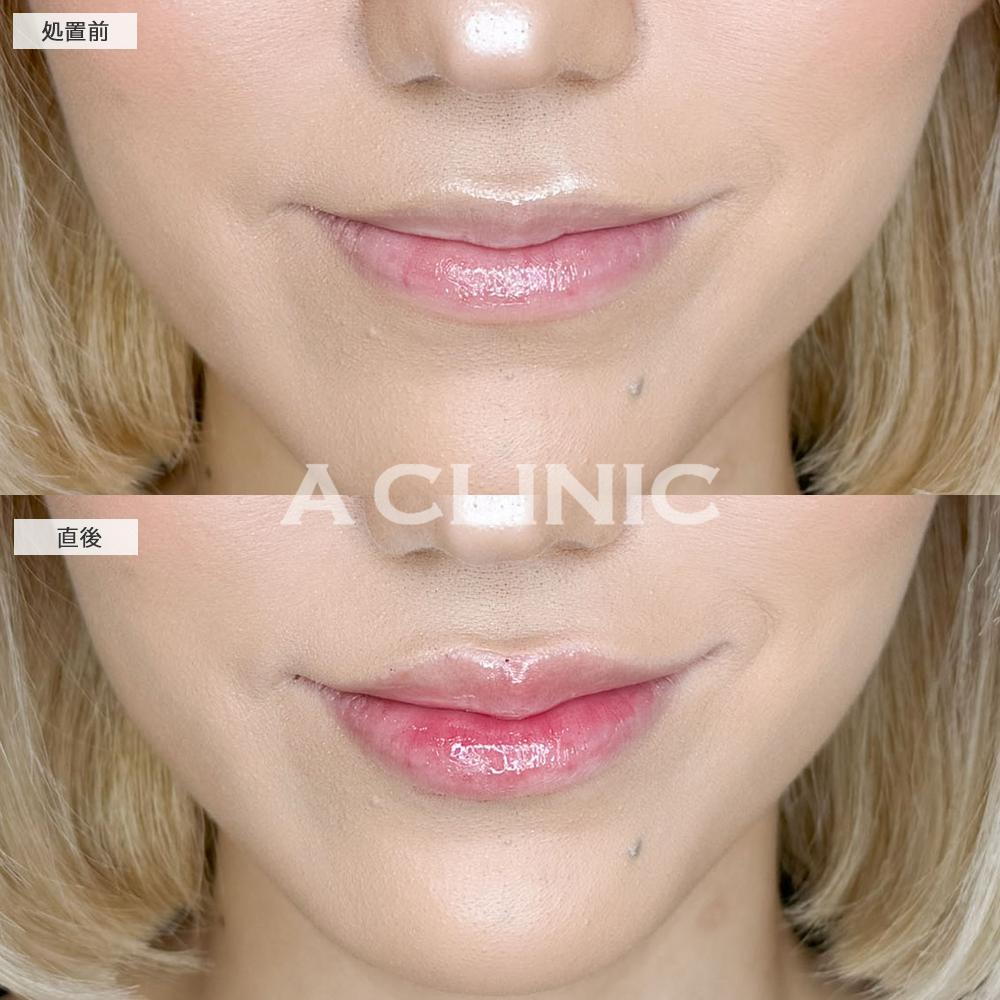 唇のヒアルロン酸注入でぷっくり印象的な口元に！こちらスマイルリップの施術前と直後の症例です(20代女性)