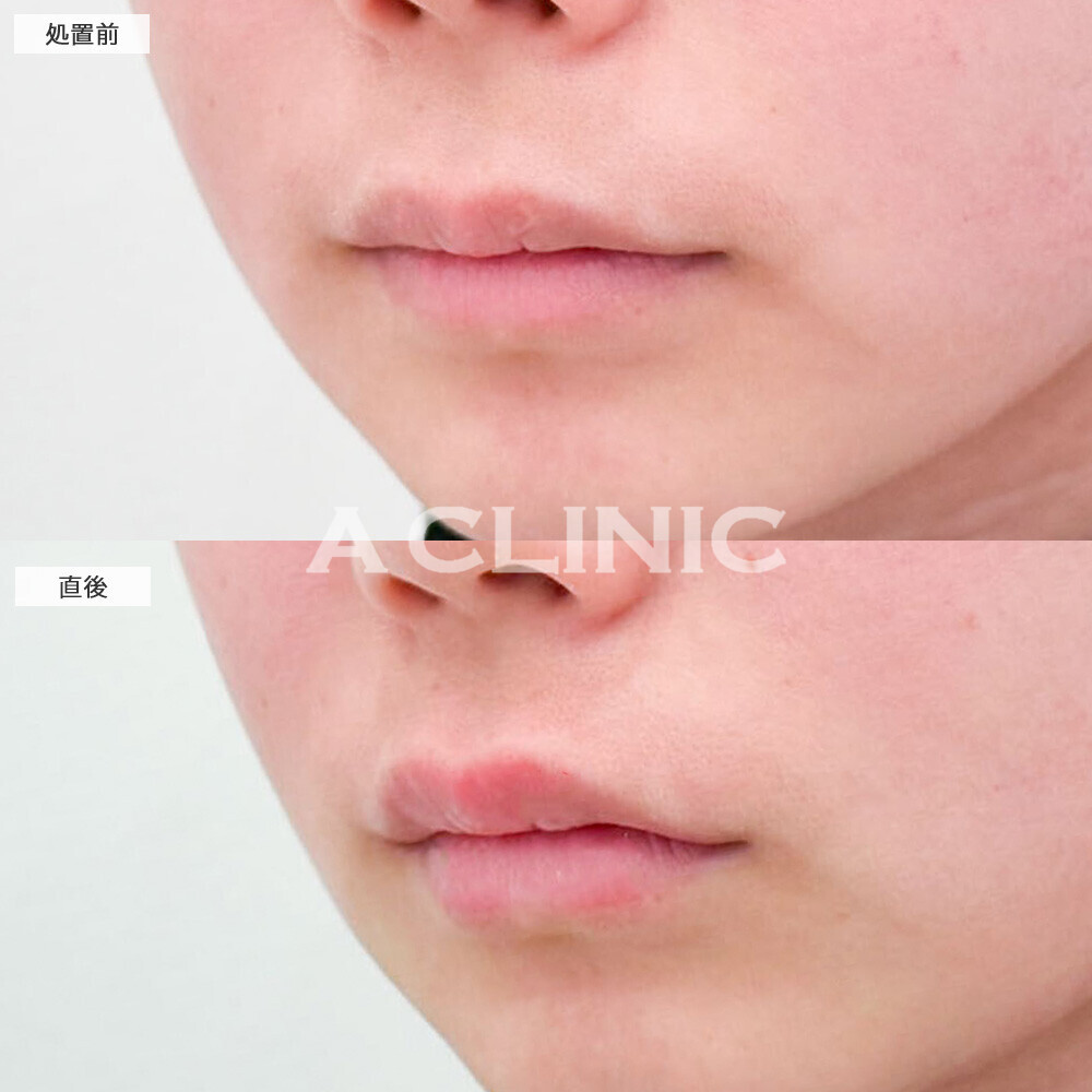 リップヒアルロン酸注入でグロスなしでも立体的な唇に！処置前と直後の症例です(20代女性)