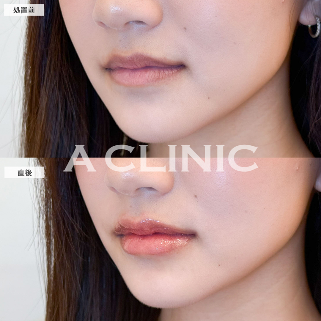 スマイルリップで人中も短くなり化粧も楽になりました！こちら処置前と直後の症例です(20代女性)