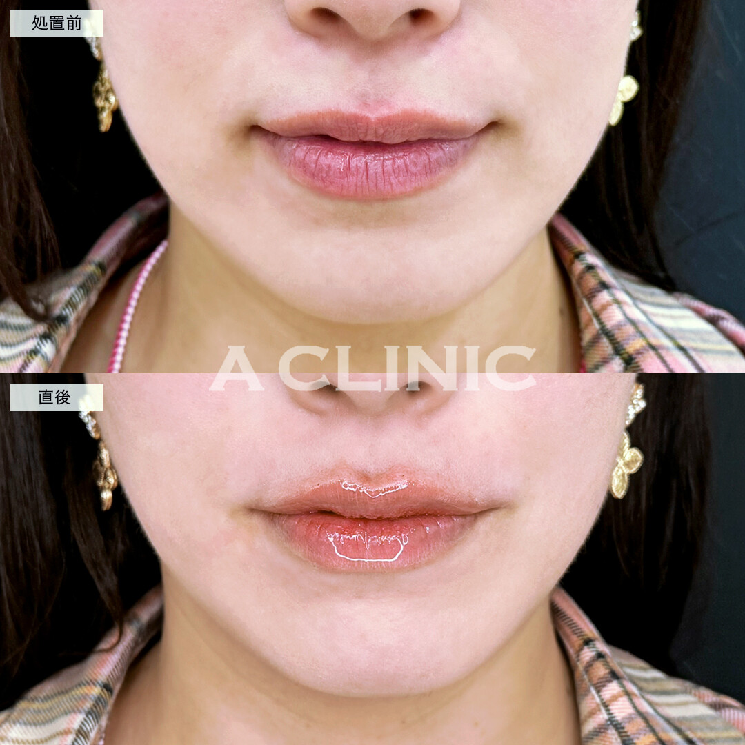 スマイルリップでメリハリのあるM字ラインが完成！施術前と直後の症例です(30代女性)