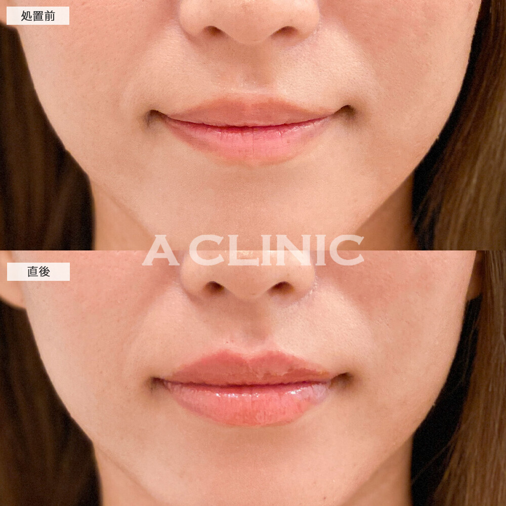 スマイルリップでナチュラルに形を整えながらボリュームアップ！こちら処置前と直後の症例です(20代女性)