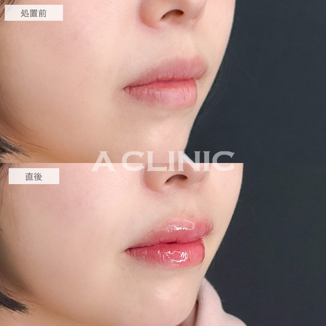 スマイルリップでM字リップになって人中も短縮！こちら処置前と直後の症例です(20代女性)