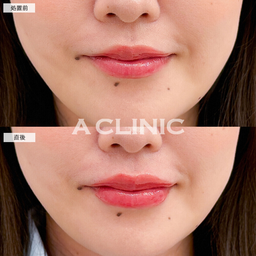 スマイルリップで適度な厚みが出てパーツがはっきりしました！こちら処置前と直後の症例です(20代女性)