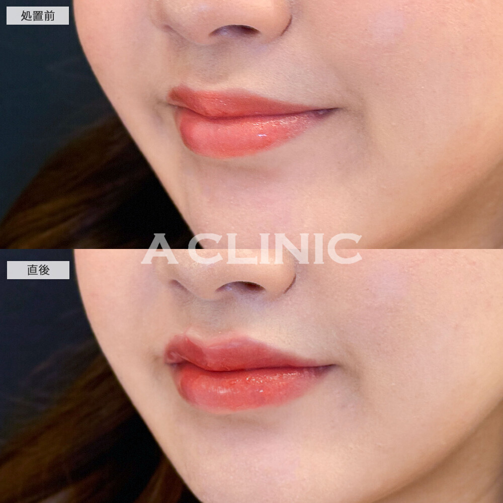スマイルリップで存在感のある可愛い唇に！こちら処置前と直後の症例です(20代女性)